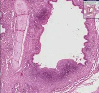 Histopathology Lung--Bronchiectasis